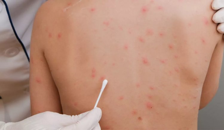 Alanya’da okul ve kreşlerde suçiçeği alarmı