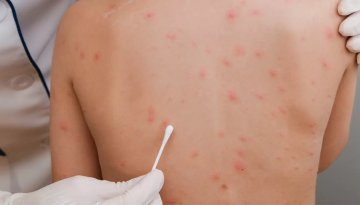 Alanya’da okul ve kreşlerde suçiçeği alarmı